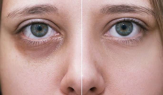 How to Get Rid of Dark Circles